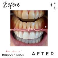 Mirror Mirror Mobile Teeth Whitening image 12