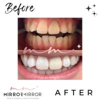 Mirror Mirror Mobile Teeth Whitening image 10