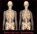 Scoliosis Support Group image 1